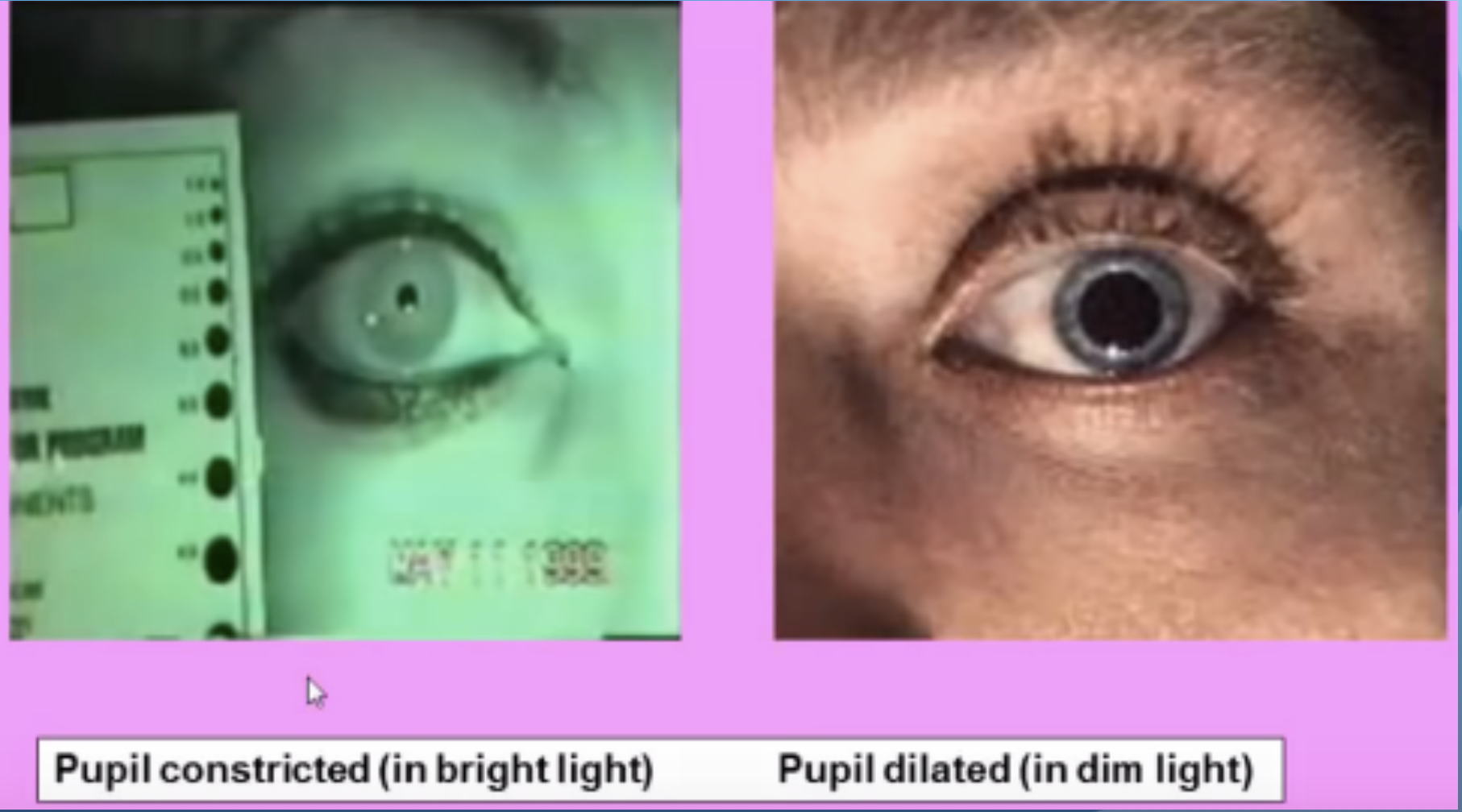 myopia projection
